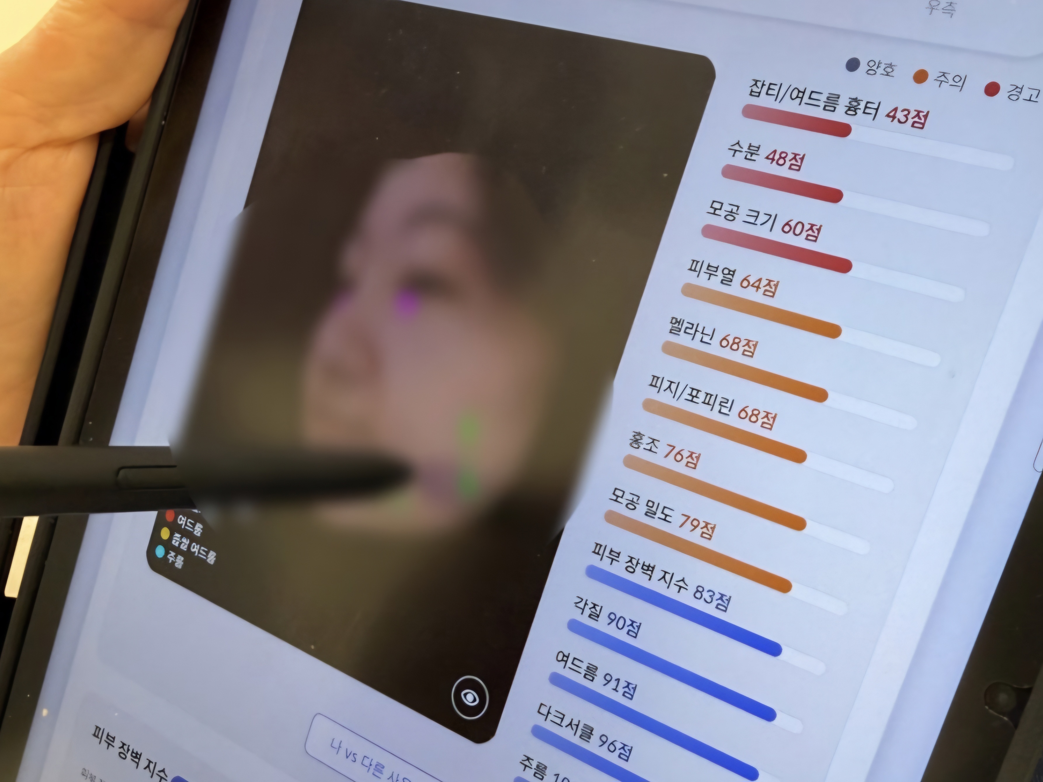 AI 피부진단 분석 화면
