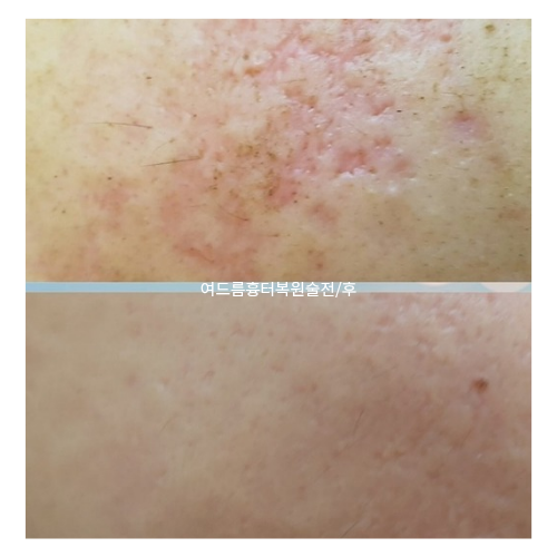 피부 변화 사례 4