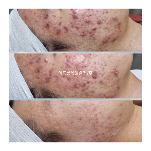 피부 변화 사례 8